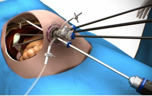 Single Incision Gastric Sleeve Surgery