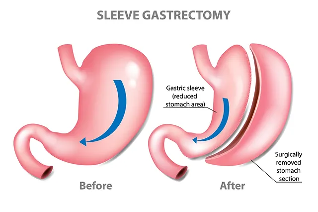 Gastric-Sleeve