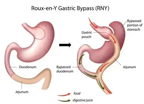 gastric-bypass-surgery