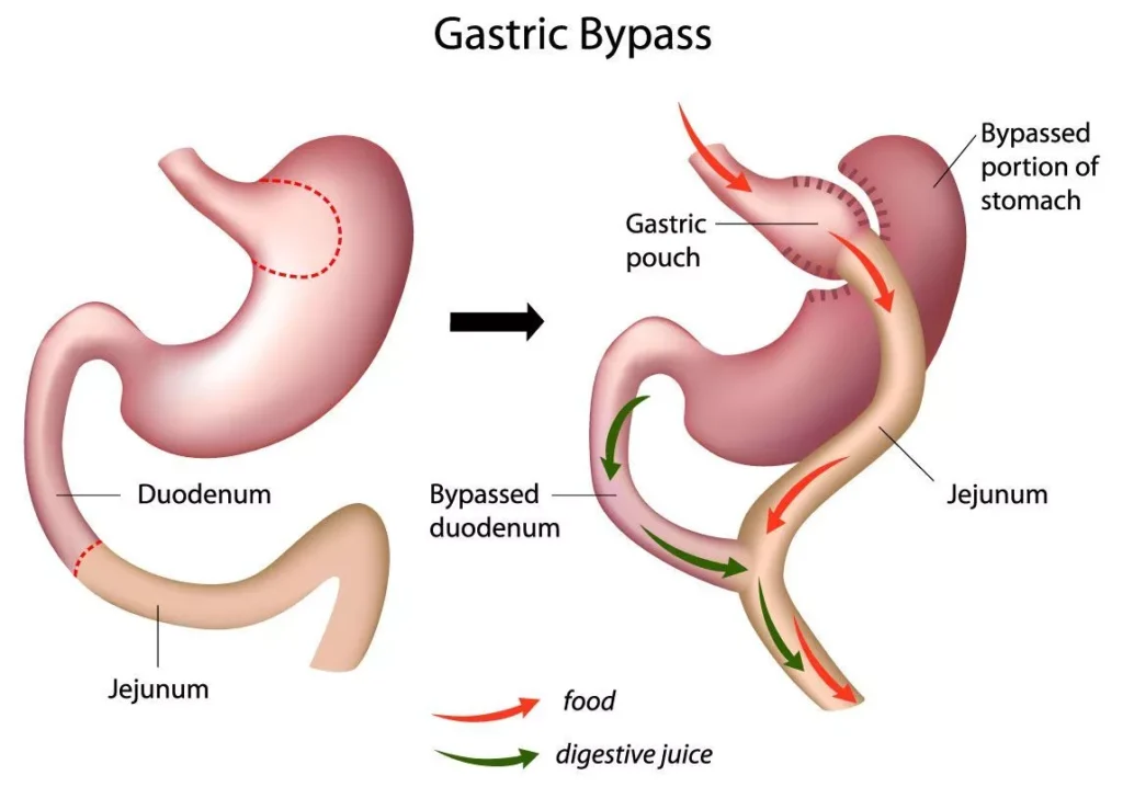 Gastric Bypass