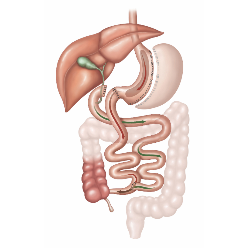 Duodenal Switch 2