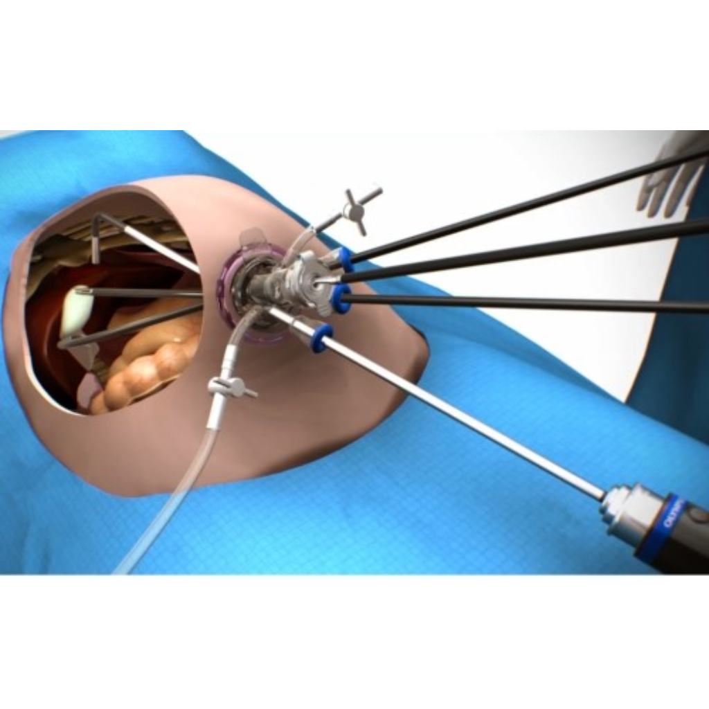 Single Incision Gastric Sleeve 2