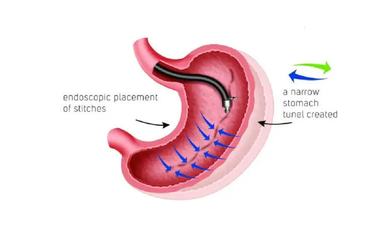 how-to-prepare-for-your-gastric-bypass-surgery-1